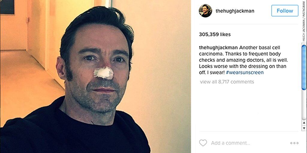 Hugh Jackman Instagram post that reads, Another basal cell carcinoma.  Thanks to frequent body checks and amazing doctors, all is well.  Looks worse with the dressing on than off. I swear! #wearsunscreen