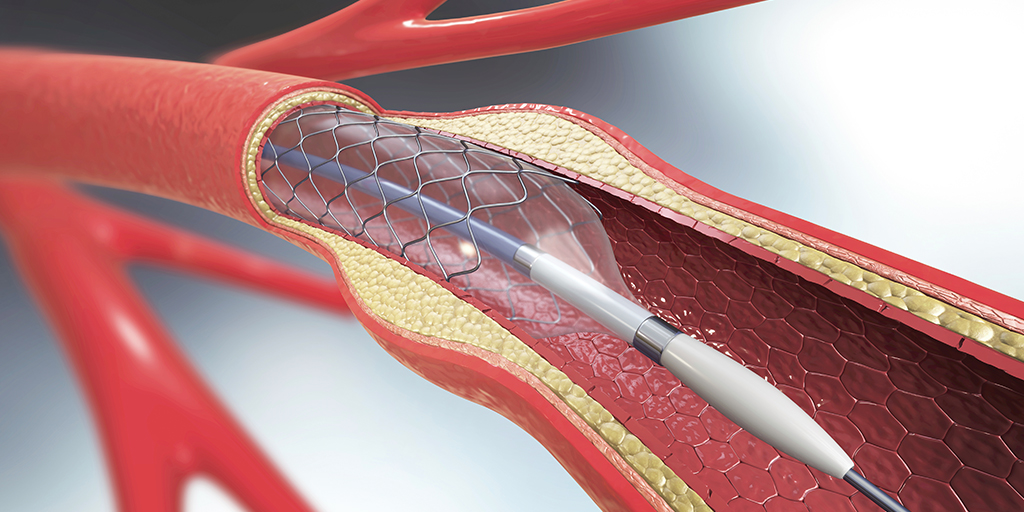 Illustration of a stent