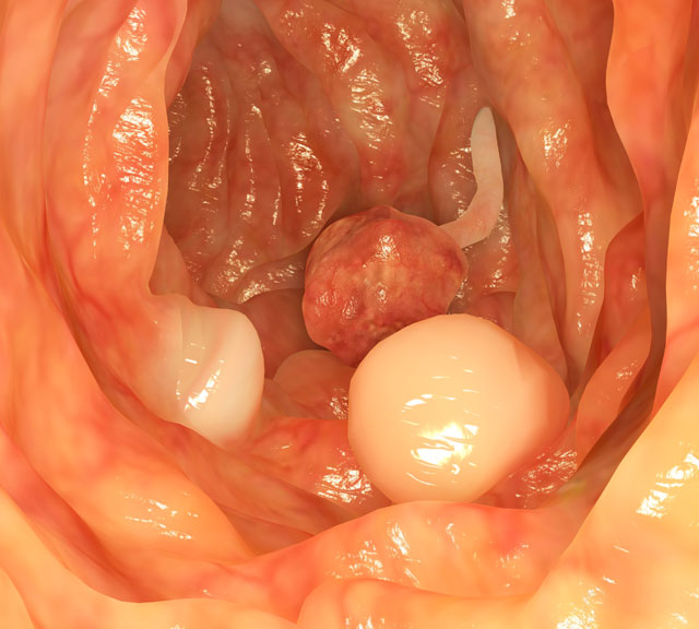 Polyps Colorectal Cancer’s Early Warning System - In Content